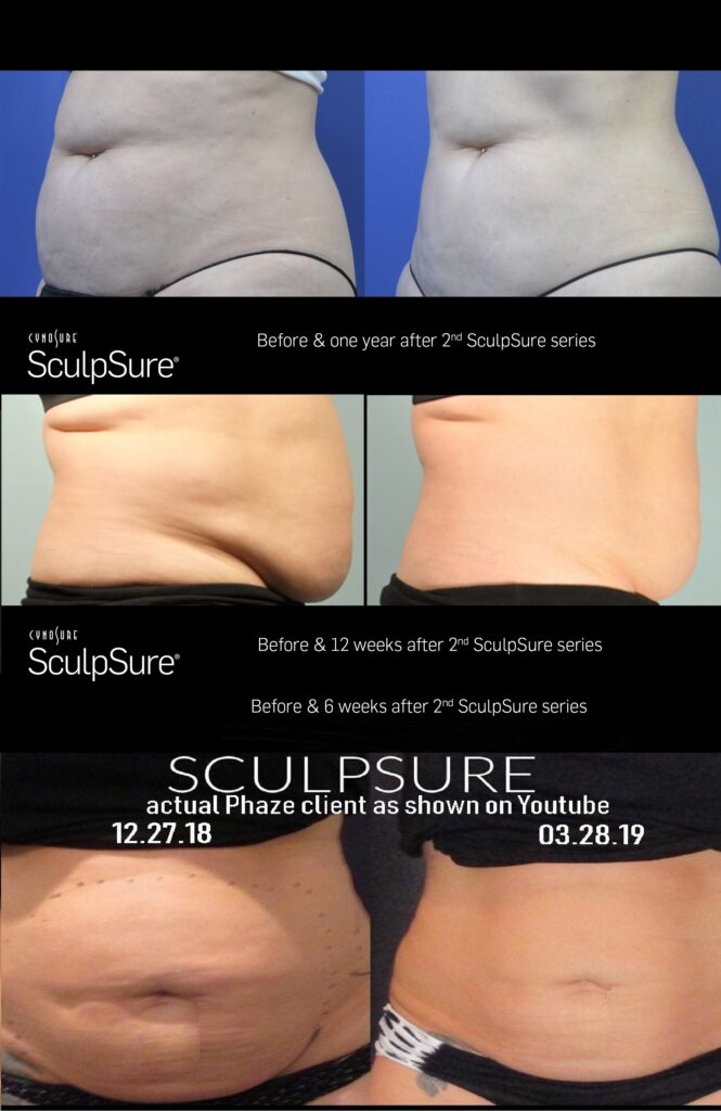body contouring in las vegas with Sculpsure laser lipolysis