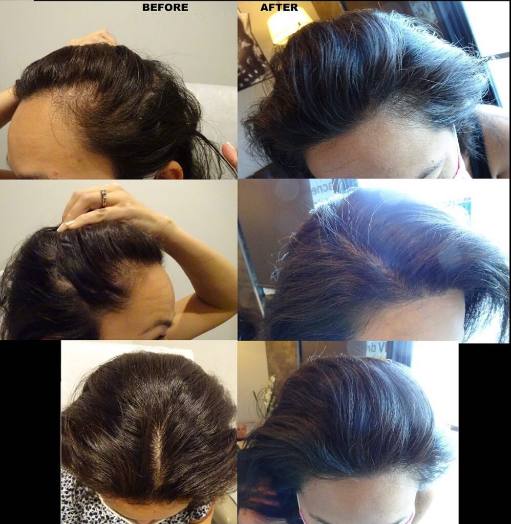female hair restoration, PRP for hair loss