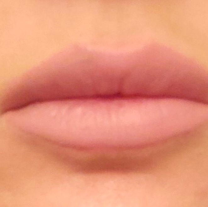 facial fillers for lip plumping Dr Thaker Phaze medical spa