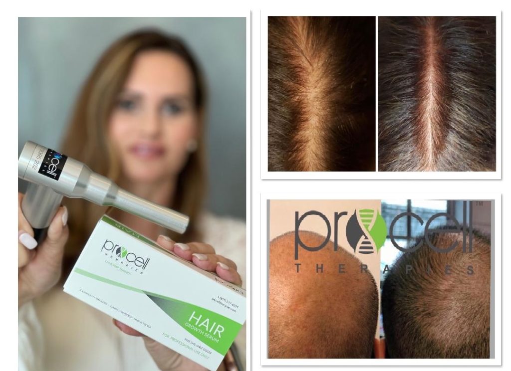 PRP and microneedling or hair restoration Las Vegas Dr Thaker