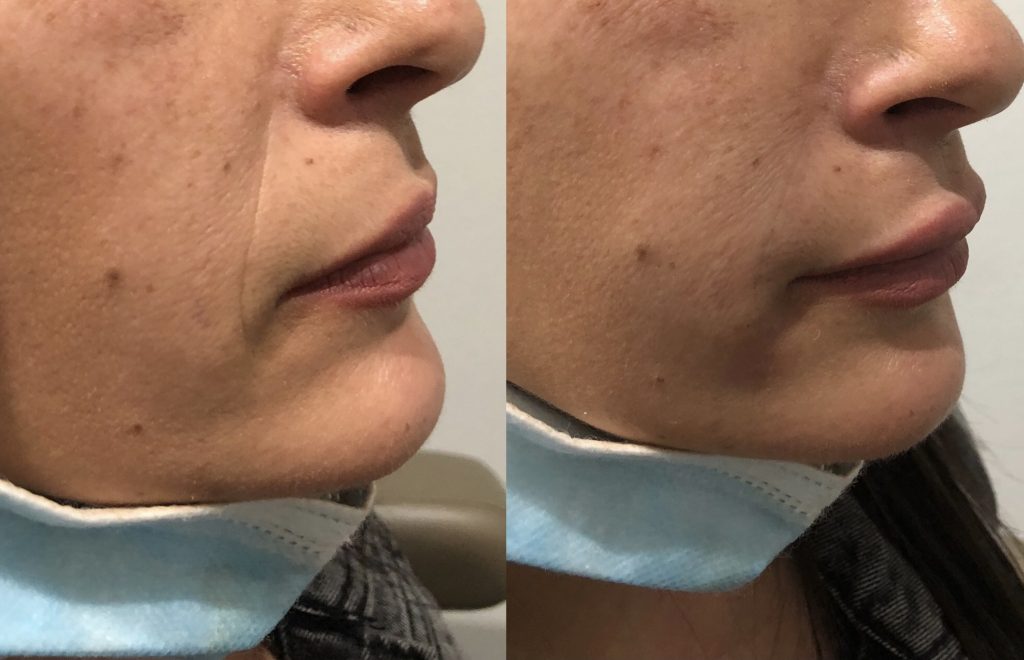facial fillers for lip plumping Dr Thaker Phaze medical spa