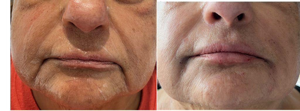 facial filler and lip filler before and after at Phaze Las Vegas